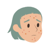 Acne scars